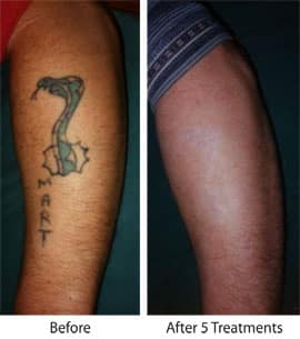 Image Result For Tattoo Removals Price Image Result For Tattoo Removals Price