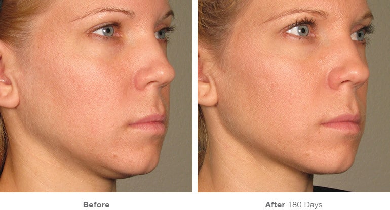 10before after ultherapy results full face23