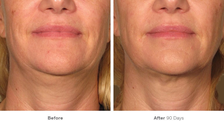 11before after ultherapy results under chin