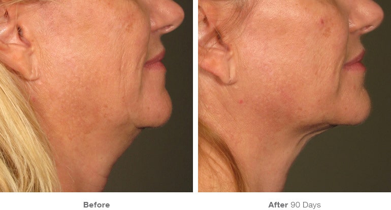12before after ultherapy results under chin
