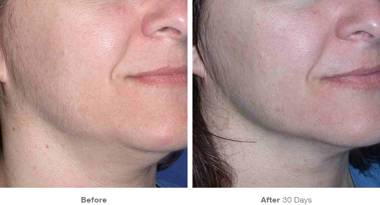 13before after ultherapy results under chin