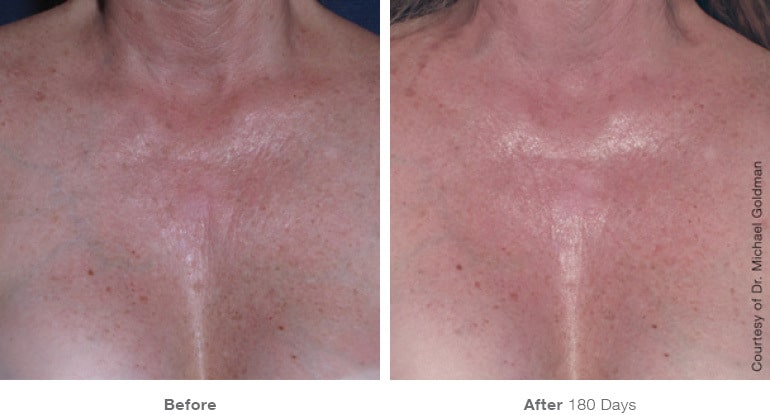 16ultherapy 0005 0093ah 180day 1tx chest gallery