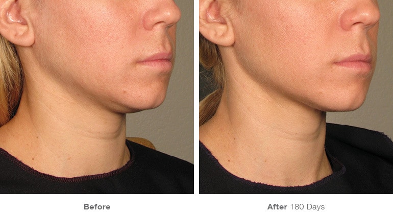 18before after ultherapy results under chin