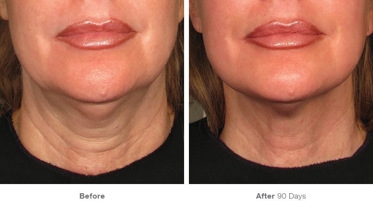 1before after ultherapy results neck