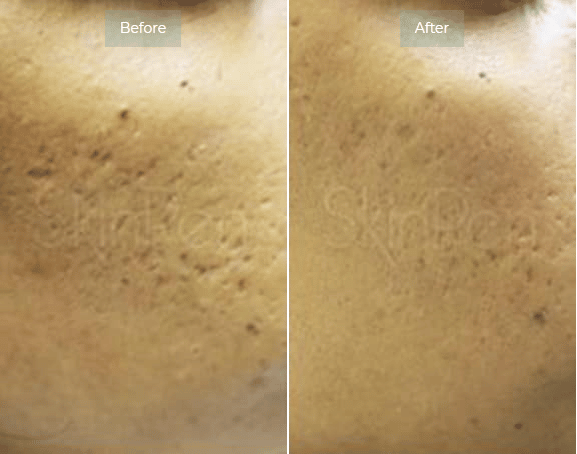 Microneedling