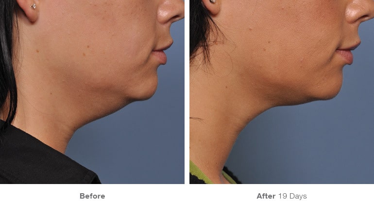 20before after ultherapy results under chin