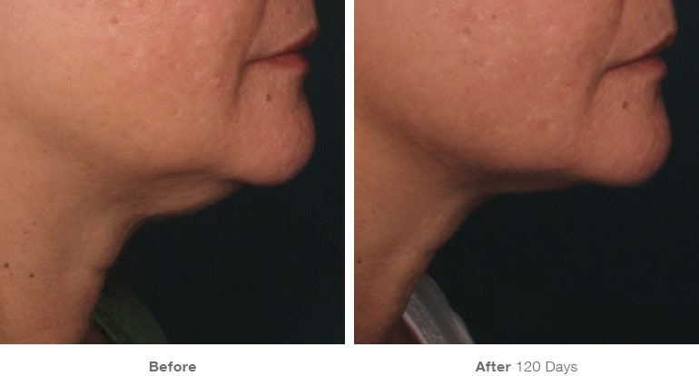2before after ultherapy results under chin