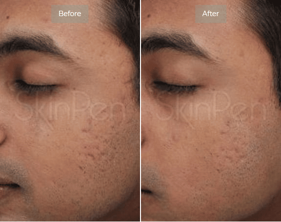 Microneedling