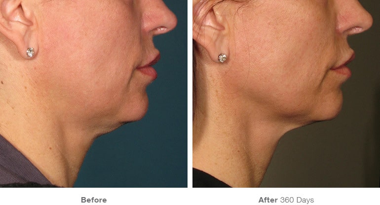 3before after ultherapy results under chin