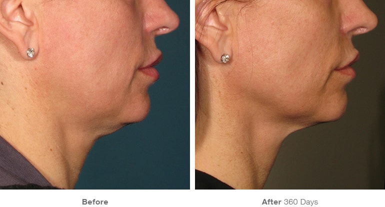 Ultherapy
