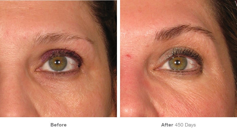 3img template beforeafter brow
