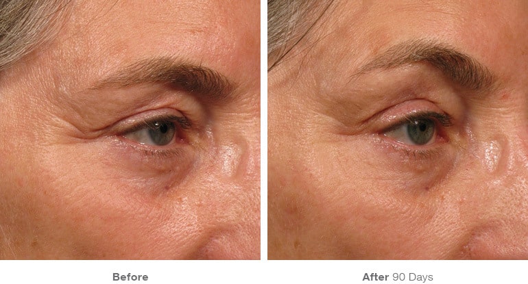 4img template beforeafter brow