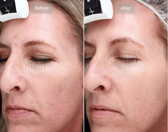 Microneedling