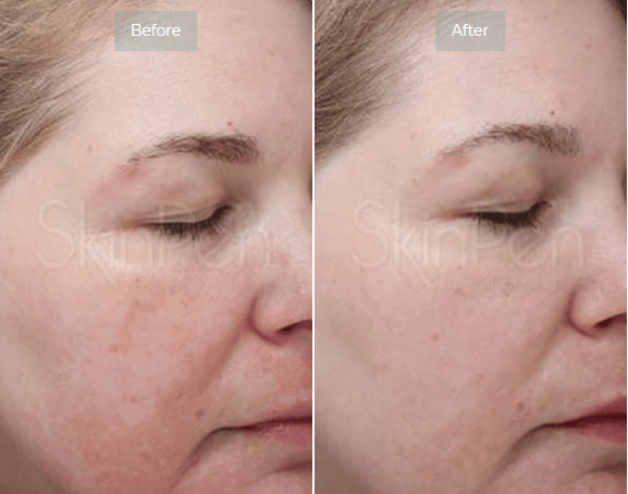 Microneedling