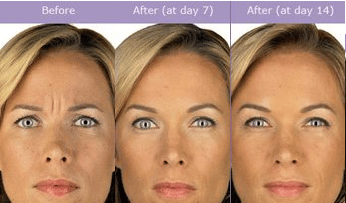 Botox Procedure in Santa Barbara - Evolutions Medical and Day Spa