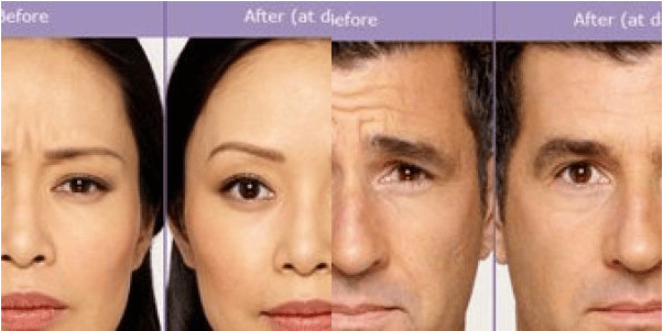 Botox Treatment in Santa Barbara - Evolutions Medical and Day Spa