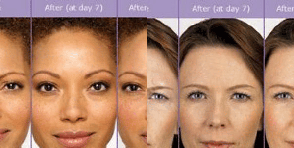 Botox - Evolutions Medical and Day Spa
