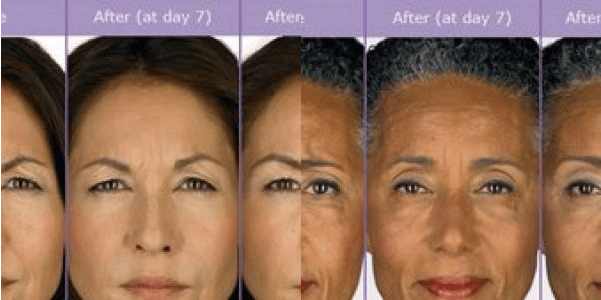 Best Botox Treatment in Santa Barbara - Evolutions Medical and Day Spa