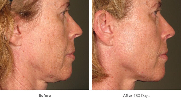 6before after ultherapy results full face15