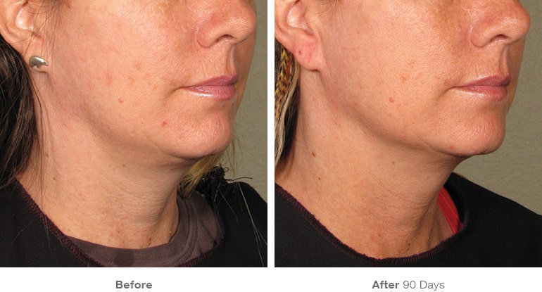 6before after ultherapy results under chin