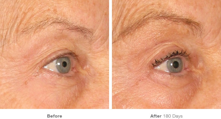 6img template beforeafter brow