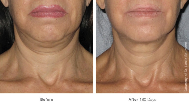 6ultherapy 0008 0086w 180day 1tx neck1 gallery 1