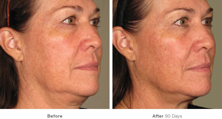 7before after ultherapy results full face20
