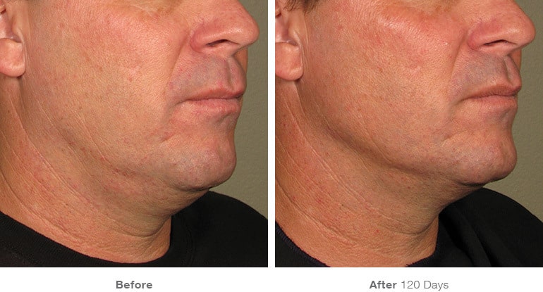 7before after ultherapy results under chin
