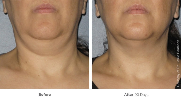 7ultherapy 0014 0086w 90day 1tx neck gallery 1