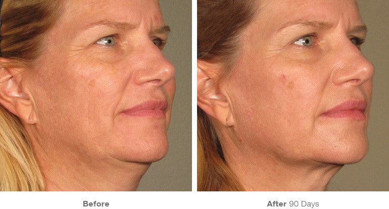 8before after ultherapy results full face21