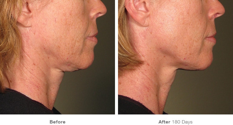 8before after ultherapy results under chin