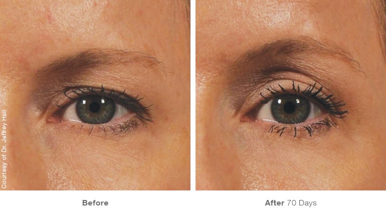 8img template beforeafter brow