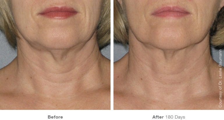 8ultherapy 0025 0086w 180day 1tx neck gallery 1