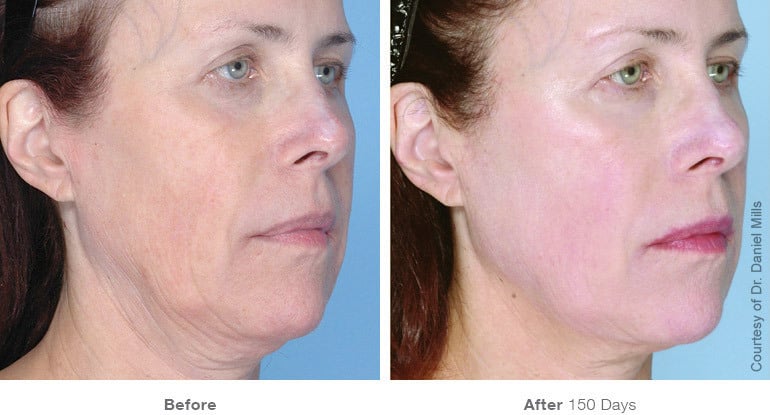 9before after ultherapy results full face22 v3