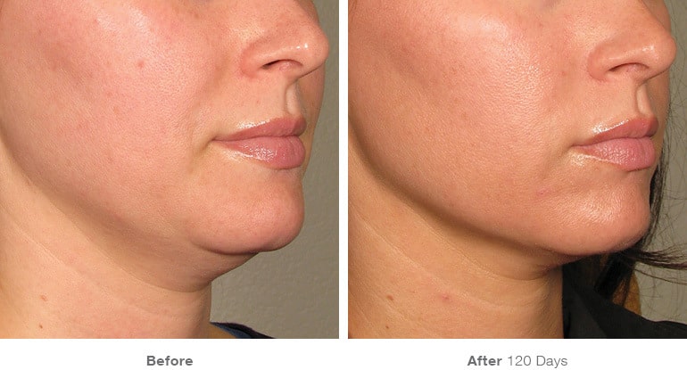 9before after ultherapy results under chin
