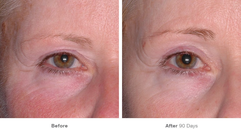 9img template beforeafter brow