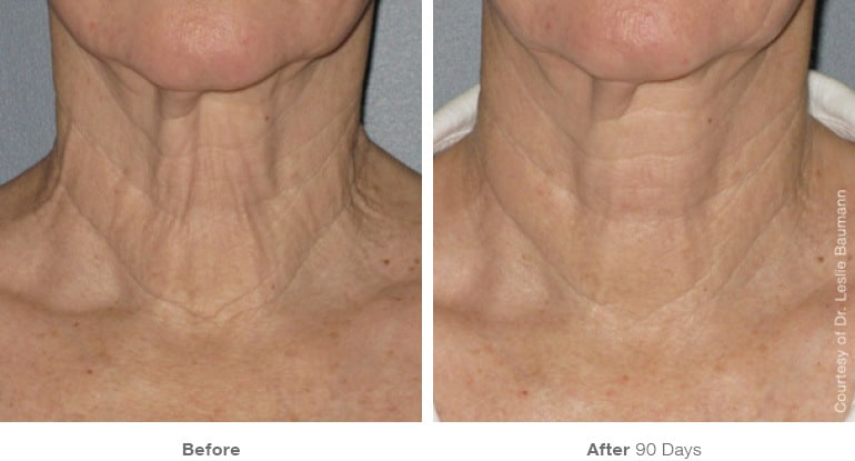 9ultherapy bl0017 90day 1tx neck gallery 1