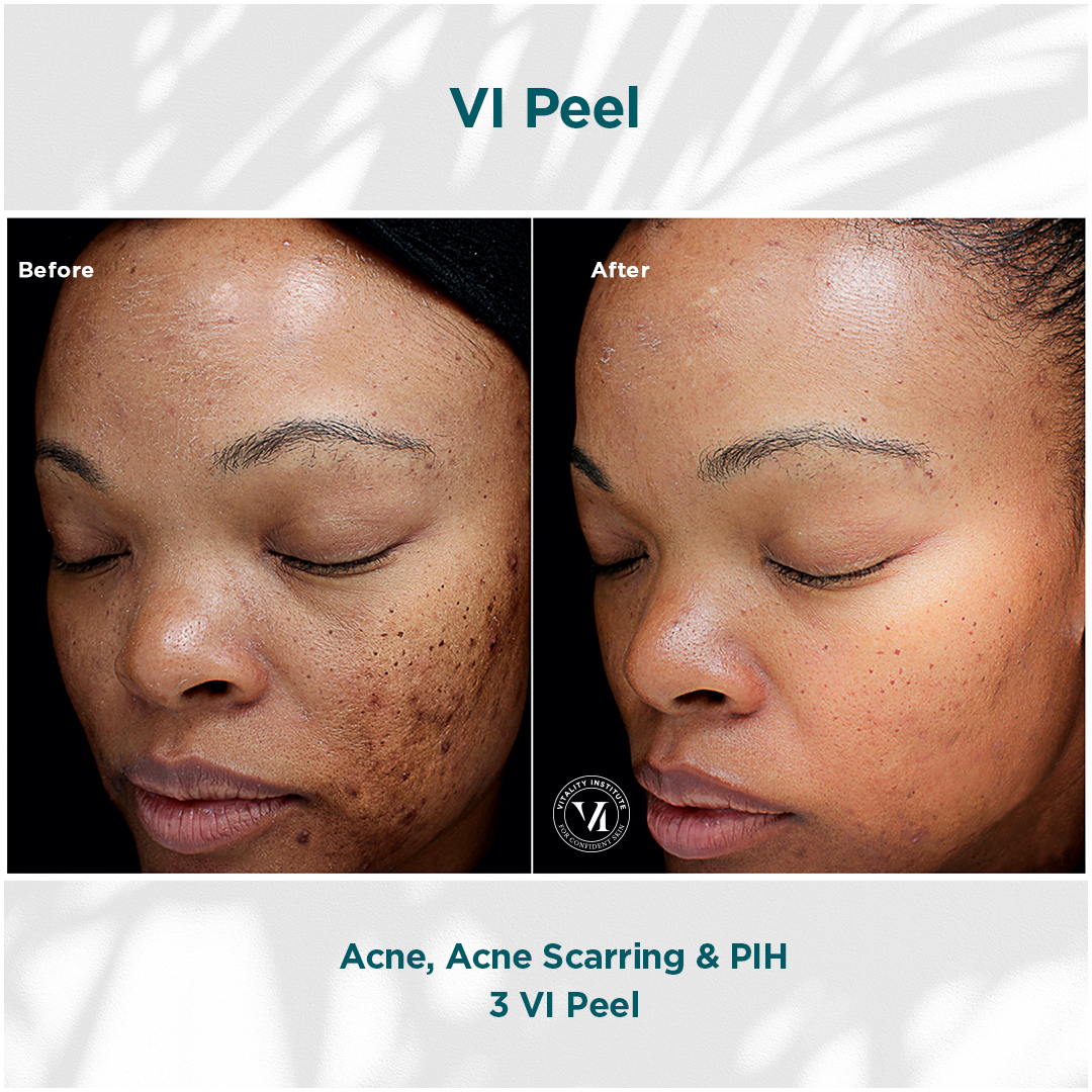 Acne Scarring Pih
