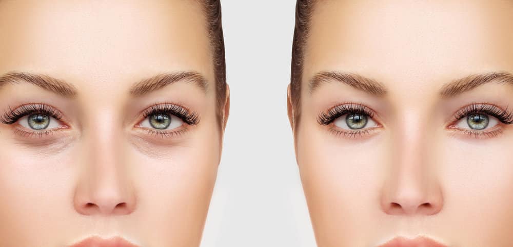 Blepharoplasty (Eyelid Surgery – Upper or Lower Lids)