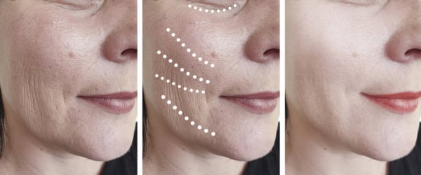 Minimally Invasive Cheek Lift in Santa Barbara 