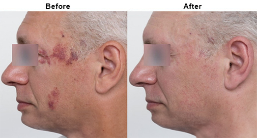 Ellipse IPL: Before And After