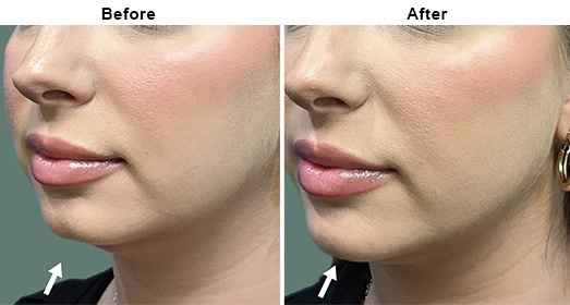 Dermal Fillers: Before And After