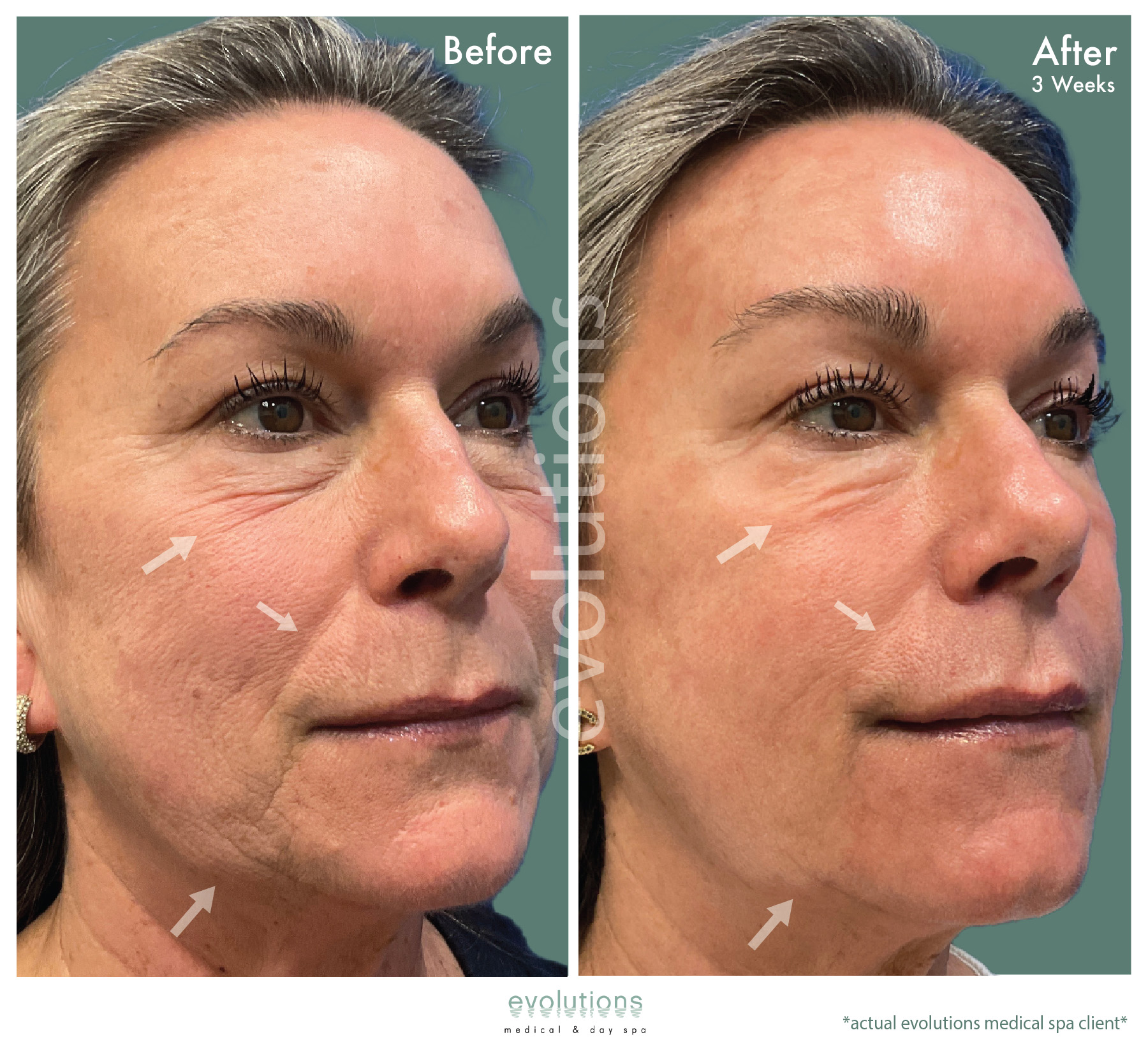 Fractional CO2 Dermal Remodeling in Santa Barbara