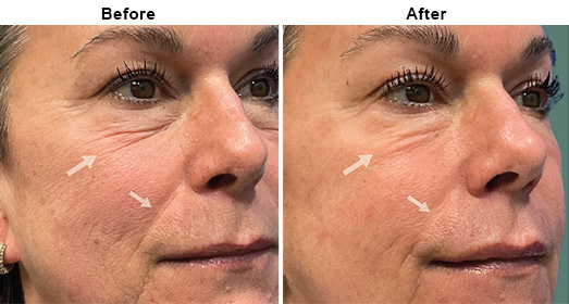 Fractional CO2 Dermal Remodeling: Before And After