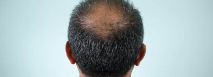 Hair Loss - Laser Hair Restoration in Santa Barbara