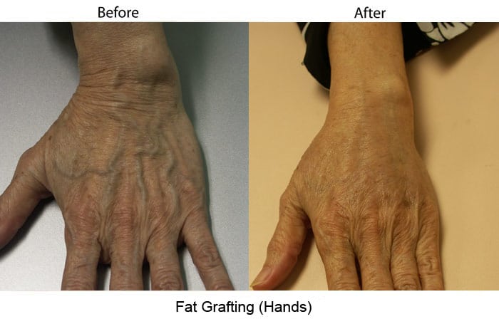 Fat Transplantation or Fat Grafting on Hands - Evolutions Medical Spa Santa Barbara