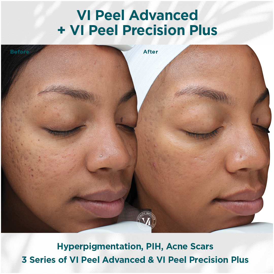 Hyperpigmentation, PIH, Acne Scars - VI Peel Treatments at Evolutions Medical & Day Spa in Santa Barbara