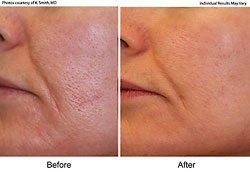 Before and After Progression - Laser Genesis Medical Spa Treatments in Santa Barbara