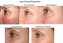 Before and After Laser Genesis Progression in Santa Barbara