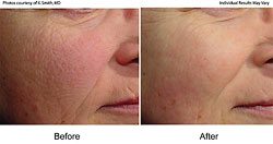 Before and After Progression - Laser Genesis Medical Spa Treatments in Santa Barbara